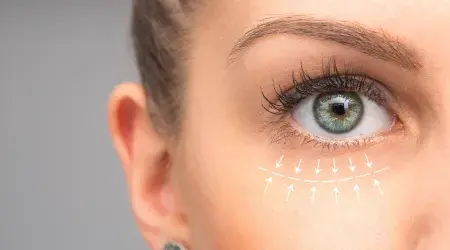 blefaroplastia
